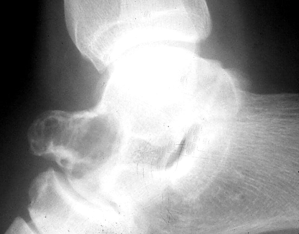 Pathology Outlines - Osteoblastoma